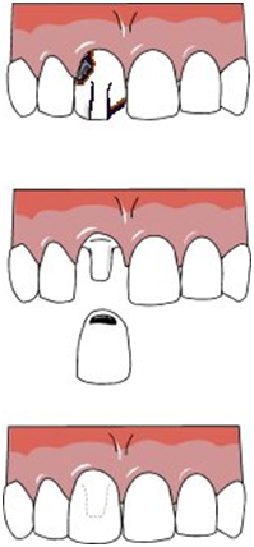 dental crown in Ashok Vihar