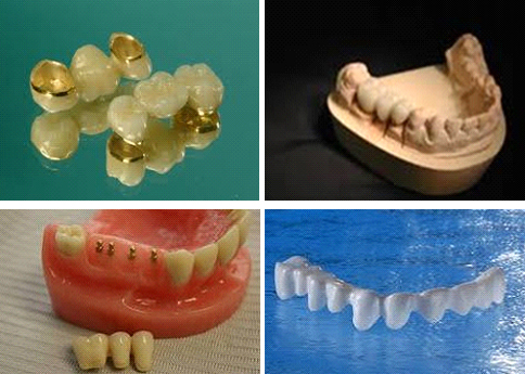 dental bridges in Ashok Vihar