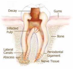 root canal treatment in Ashok Vihar