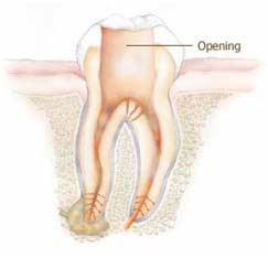 root canal treatment in Ashok Vihar