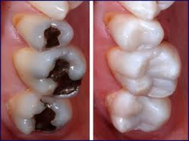 PORCELAIN CROWNS/BRIDGES