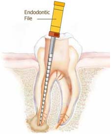 root canal treatment in Ashok Vihar