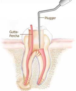 root canal treatment in Ashok Vihar