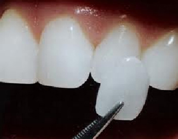 dental veneers in Ashok Vihar