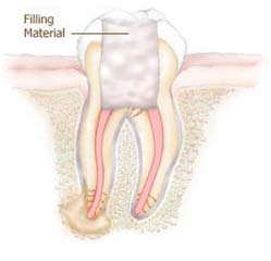 root canal treatment in Ashok Vihar