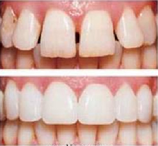 dental veneers in Ashok Vihar