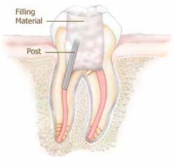 root canal treatment in Ashok Vihar