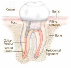 root canal treatment in Ashok Vihar