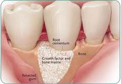 bone grafting in Ashok Vihar