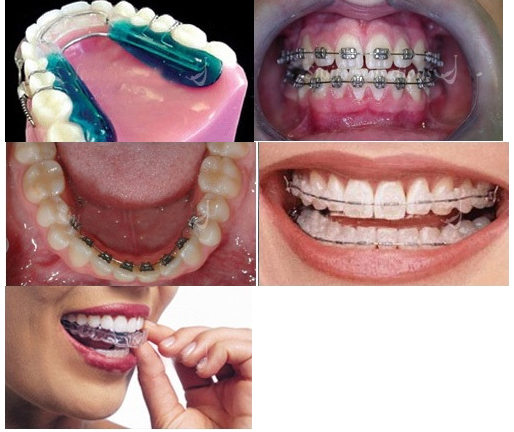 dental braces in Ashok Vihar
