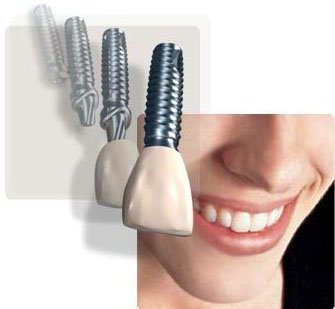 Dental Implants in Ashok Vihar