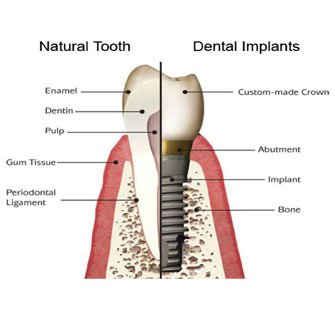 tooth implant in Ashok Vihar