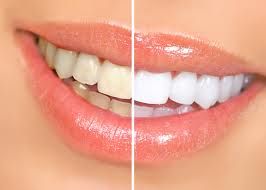 Teeth Whitening in Ashok Vihar